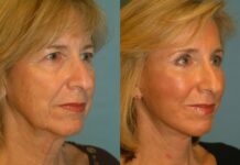 Newest Trends in Facial Rejuvenation